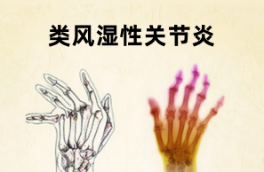 类风湿性疾病